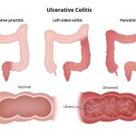 colita-ulcerativa