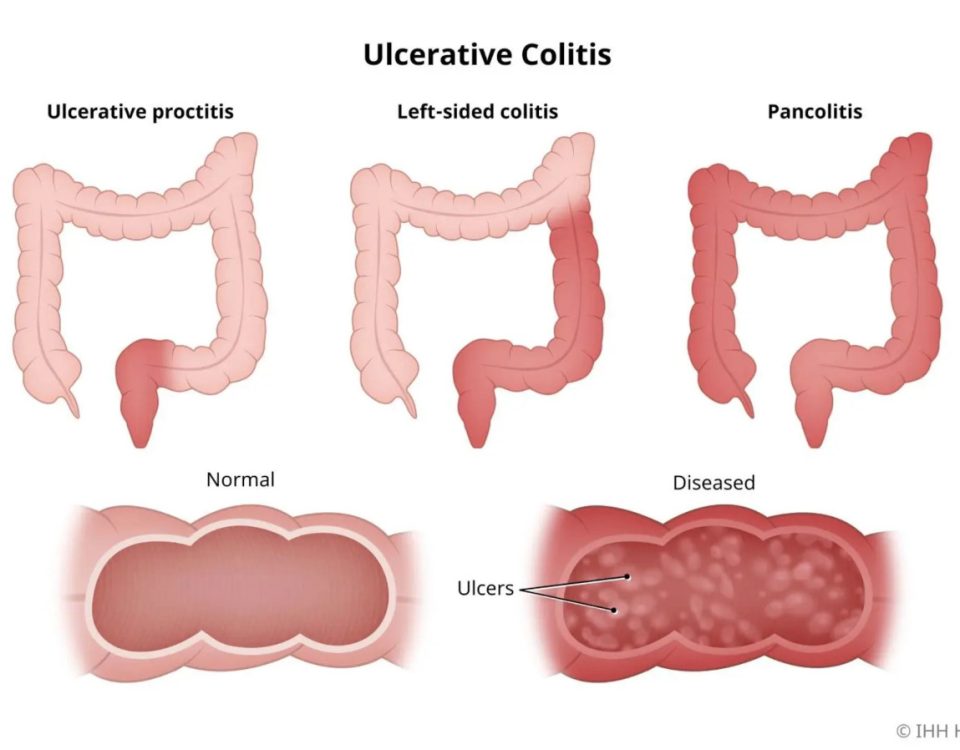 colita-ulcerativa